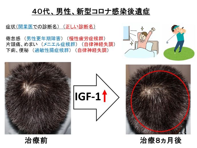新型コロナ感染後遺症　治療